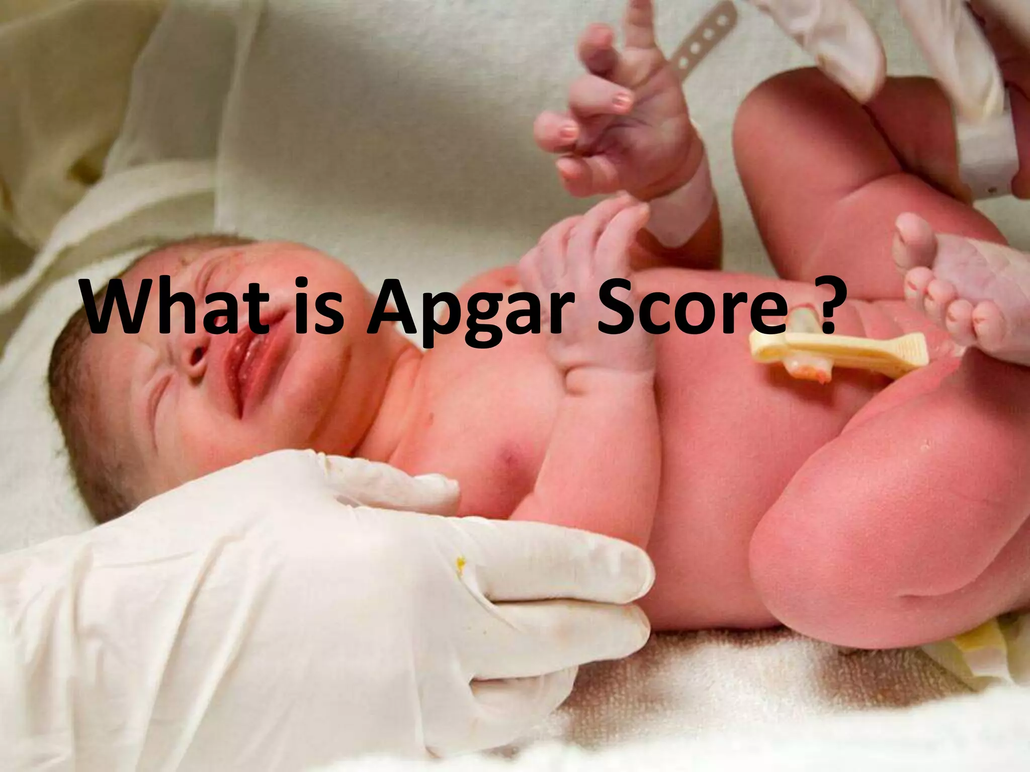 What is Apgar Score ?
 
