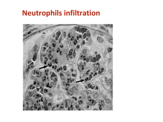 Neutrophils infiltration
 