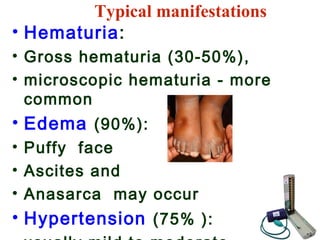 • Hematuria:
• Gross hematuria (30-50%),
• microscopic hematuria - more
common
• Edema (90%):
• Puffy face
• Ascites and
• Anasarca may occur
• Hypertension (75% ):
Typical manifestations
 