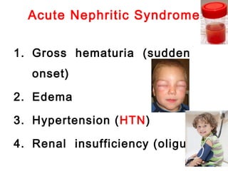 Acute Nephritic Syndrome
1. Gross hematuria (sudden
onset)
2. Edema
3. Hypertension (HTN)
4. Renal insufficiency (oliguria)
 