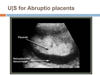 U|S for Abruptio placenta
 