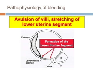 Pathophysiology of bleeding
Avulsion of villi, stretching of
lower uterine segment
 