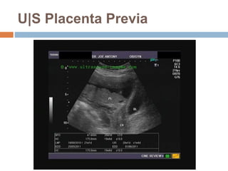 U|S Placenta Previa
 