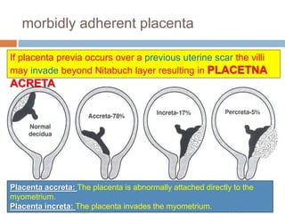 morbidly adherent placenta
Placenta accreta: The placenta is abnormally attached directly to the
myometrium.
Placenta increta: The placenta invades the myometrium.
If placenta previa occurs over a previous uterine scar the villi
may invade beyond Nitabuch layer resulting in PLACETNA
ACRETA
 
