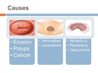 Causes
• Erosion
• Polyps
• Cancer
• Varicosities
• Lacerations
• Abraptio p.
• Placenta p.
• Vasa previa
 