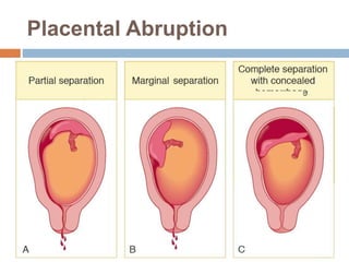Placental Abruption
 