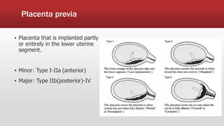 Placenta previa
▪ Placenta that is implanted partly
or entirely in the lower uterine
segment.
▪ Minor: Type I-IIa (anterior)
▪ Major: Type IIb(posterior)-IV
 