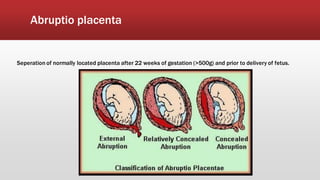 Abruptio placenta
Seperation of normally located placenta after 22 weeks of gestation (>500g) and prior to delivery of fetus.
 