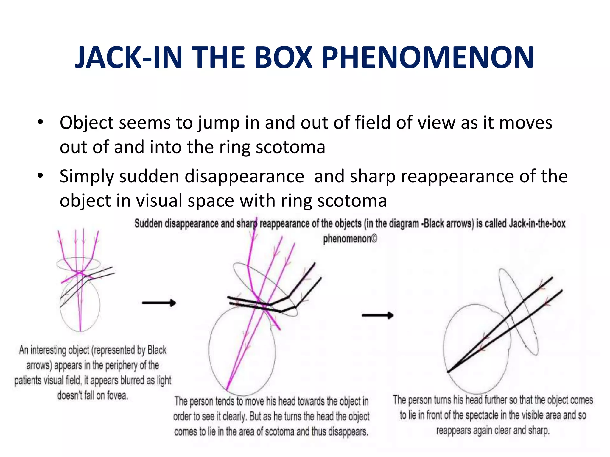 JACK-IN THE BOX PHENOMENON
• Object seems to jump in and out of field of view as it moves
out of and into the ring scotoma
• Simply sudden disappearance and sharp reappearance of the
object in visual space with ring scotoma
 