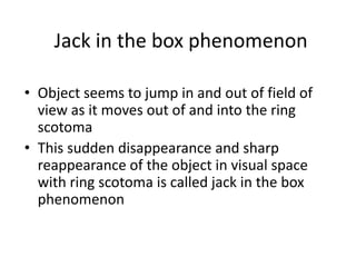 Jack in the box phenomenon
• Object seems to jump in and out of field of
view as it moves out of and into the ring
scotoma
• This sudden disappearance and sharp
reappearance of the object in visual space
with ring scotoma is called jack in the box
phenomenon
 