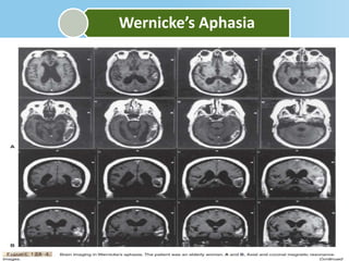Wernicke’s Aphasia
 