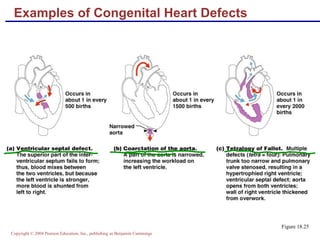 Examples of Congenital Heart Defects Figure 18.25 