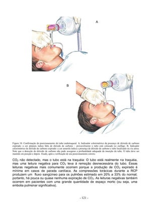 - 121 -
A
B
Figura 10. Confirmação do posicionamento do tubo endotraqueal. A, Indicador colorimétrico da presença de dióxido de carbono
expirado: a cor púrpura indica falta de dióxido de carbono – provavelmente o tubo está colocado no esôfago. B, Indicador
colorimétrico de dióxido de carbono expirado: a cor amarela indica a presença de dióxido de carbono e tubo localizado na via aérea.
Note que a detecção do dióxido de carbono não pode assegurar a profundidade adequada da inserção do tubo. O tubo deve ser
mantido em posição e depois fixado, após a verificação de seu posicionamento correto.
CO2 não detectado, mas o tubo está na traquéia: O tubo está realmente na traquéia,
mas uma leitura negativa para CO2 leva à remoção desnecessária do tubo. Essas
leituras negativas mais comumente ocorrem porque a produção de CO2 expirado é
mínima em casos de parada cardíaca. As compressões torácicas durante a RCP
produzem um fluxo sangüíneo para os pulmões estimado em 20% a 33% do normal;
portanto, há pouca ou quase nenhuma expiração de CO2. As leituras negativas também
ocorrem em pacientes com uma grande quantidade de espaço morto (ou seja, uma
embolia pulmonar significativa).
 