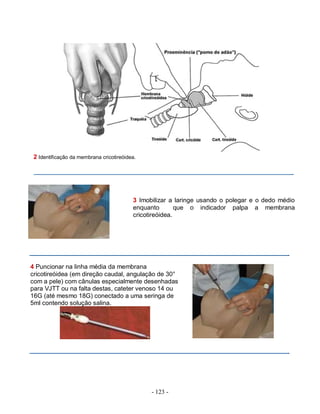 - 123 -
2 Identificação da membrana cricotireóidea.
3 Imobilizar a laringe usando o polegar e o dedo médio
enquanto que o indicador palpa a membrana
cricotireóidea.
4 Puncionar na linha média da membrana
cricotireóidea (em direção caudal, angulação de 30°
com a pele) com cânulas especialmente desenhadas
para VJTT ou na falta destas, cateter venoso 14 ou
16G (até mesmo 18G) conectado a uma seringa de
5ml contendo solução salina.
 