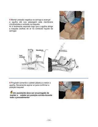 - 124 -
5 Manter pressão negativa na seringa e avançar
a agulha até sua passagem pela membrana
cricotireóidea e entrada na traquéia.
Ar é facilmente aspirado logo que a agulha atinge
a traquéia (bolhas de ar no conteúdo líquido da
seringa)
6 Progredir somente o cateter plástico e retirar a
agulha. Novamente aspirar ar para confirmar a
posição traqueal.
Um assistente deve ser encarregado de
manter o cateter em posição correta durante
todo o procedimento!
 