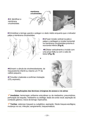 - 129 -
2. Identificar a
membrana
cricotireóidea.
3.Imobilizar a laringe usando o polegar e o dedo médio enquanto que o indicador
palpa a membrana cricotireóidea.
4.Fazer incisão vertical na pele e
palpar a cartilagem e incisão horizontal
na membrana cricotireóidea próxima à
sua borda inferior (Fig.A).
5.Dilatar verticalmente a incisão com
uma pinça Kelly ou com o cabo do
bisturi (Fig. B).
6.Inserir a cânula de cricotireoidostomia, de
traqueostomia infantil ou mesmo um TT de
calibre pequeno.
7.Insuflar o balonete e confirmar intubação
(CO2 expirado).
Complicações das técnicas cirúrgicas de acesso a via aérea:
Imediatas: hemorragia; enfisema subcutâneo ou de mediastino; pneumotórax,
perfuração de traquéia, mediastino ou esôfago; lesão de corda vocal; aspiração do
conteúdo gástrico; rotura de laringe; hipercarbia.
Tardias: estenose traqueal ou subglótica; aspiração; fístula traqueo-esofágica;
mudança na voz; infecção; sangramento; traqueomalacia.
 
