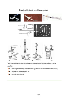 - 130 -
Cricotireoidostomia com kits comerciais
Técnica de inserção da cânula de cricotireoidostomia já acoplada a uma
agulha:
A - introdução do conjunto cânula + agulha na membrana cricotireóidea;
B - aspiração positiva para ar;
C - cânula em posição
 
