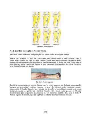 - 152 -
Fig 12.2 – Tipos de fratura
1.1.2. Quanto à exposição do foco de fratura
Fechada: o foco de fratura está protegido por partes moles e com pele Integra.
Aberta ou exposta: o foco de fratura está em contato com o meio externo, com o
osso exteriorizado ou não. A pele, nestes casos, está sempre lesada. O grau de lesão
dessas partes moles permite classificar as fraturas expostas. A lesão da pele pode ocorrer
pelo trauma, pelos fragmentos ósseos e pelo manuseio intempestivo da vítima, tornando
uma fratura fechada em aberta.
Fig 12.3 – Fratura exposta
Devido a comunicação do foco de fratura com o meio externo, as fraturas expostas são
sempre contaminadas, variando apenas o grau de contaminação, podendo causar
osteomielite (infecção óssea), que retarda ou impede a consolidação óssea; em casos
extremos, causa a perda do membro lesado. Em casos mais graves, a infecção
dissemina-se pelo organismo (septicemia) e, em pacientes debilita- dos, leva a óbito. A
fratura exposta é uma situação de urgência se não for acompanhada de choque.
 
