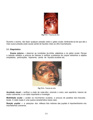 211
Fig 17.3 – Trauma de olho
Durante o exame, não fazer qualquer pressão sobre o globo ocular, lembrando-se de que até a
mais suave pressão pode causar perda de líquidos vitais ao olho traumatizado.
3.1. Diagnóstico
Exame externo – observar as condições da órbita, pálpebras e do globo ocular. Pai-par
o rebordo orbitário a procura de fraturas e verificar a presença de corpos estranhos e objetos
empalados, perfurações, hiperemia, perda de líquidos oculares etc.
Fig 17.4 – Trauma de olho
Acuidade visual – verificar a visão de cada olho, ocluindo o outro, sem apertá-lo; mesmo de
modo rudimentar, é um dado importante a investigar.
Mobilidade ocular – avaliar os movimentos oculares, a procura de paralisia dos músculos
locais. A visão dupla é uma queixa característica nesse caso.
Reação pupilar – a pesquisa dos reflexos foto motores das pupilas é importantíssima nos
traumatismos cranianos.
 