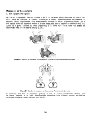 341
Massagem cardíaca externa
a. Sem equipamento especial
O local da compressão torácica durante a MCE no paciente adulto deve ser no centro do
tórax entre os mamilos. A correta localização é obtida determinando-se inicialmente o
rebordo costal, seguindo-se este medialmente localiza-se então o apêndice xifóide. Dois a
três dedos acima do apêndice xifóide é o local adequado para a depressão esternal (Fig. 19).
Aplica-se a parte saliente da mão (hipotenar) e a outra mão sobre esta. Os dedos do
reanimador não devem tocar o tórax (Fig. 20).
Figura 19 - Manobra de massagem cardíaca externa. Localização do sítio da compressão torácica.
Figura 20 - Manobra de massagem cardíaca externa. Posicionamento das mãos.
O reanimador deve ficar de preferência ajoelhado ao lado do paciente, discretamente afastado, com
os braços estendido e as mãos adequadamente posicionadas sobre o esterno, usando o seu peso na
compressão do tórax e o quadril como um fulcro (Fig. 21.
 