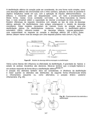 347
A desfibrilação elétrica do coração pode ser considerada, de uma forma muito simples, como
uma descarga elétrica não sincronizada com o ritmo cardíaco, aplicado no tórax do paciente.O
objetivo terapêutico reside em que, com a aplicação de impulso elétricomonofásico ou
bifásico, o miocárdio pode ser despolarizado como um todo e simultaneamente.
Desta forma, nestas novas condições com todas as fibras musculares na mesma
fase, o nodo sinoatrial obtém a capacidade de retomar a condução do ritmo cardíaco.
Existem diferenças da resposta miocárdica com relação ao tipo de onda de descarga
elétrica aplicada. Os desfibriladores mais antigos empregavam o modelo de descarga
monofásico. Estes modelos necessitam de maiores níveis de energia para uma
desfibrilação efetiva. Os desfibriladores modernos, incluindo o desfibrilador elétrico
automático (DEA), utilizamo modelo de descarga bifásica, osquais apresentam
uma superioridade na resposta do coração a descarga elétrica (85 a 94%). Estes
últimos utilizam menor nível de energia com uma resposta positiva mais comum ( Fig. 28).
Figura 28 Modelos de descarga elétrica empregado na desfibrilação.
Vários outros fatores têm influencia na efetividade da desfibrilação. A gravidade da hipóxia e
estado de acidose miocárdica são decisivos. Deve-se lembrar que o coração hipóxico e
em acidose responde de forma tênue a desfibrilação elétrica46;62;77.
A posição dos eletrodos também deve ser considerada. A eficiência da desfibrilação
é maior quando os eletrodos são distribuídos da seguinte forma: infraclavicular direita
e inframamária esquerda ou, como alternativa, a posição ântero- posterior
inframamária (Fig. 29).
Fig. 29 – Posicionamento dos eletrodos e
desfibrilação
 