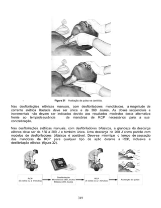349
Figura 31 Avaliação de pulso na carótida.
Nas desfibrilações elétricas manuais, com desfibriladores monofásicos, a magnitude de
corrente elétrica liberada deve ser única e de 360 Joules. As doses seqüenciais e
incrementais não devem ser indicadas devido aos resultados modestos desta alternativa
frente ao tempodeausência de manobras de RCP necessários para a sua
concretização.
Nas desfibrilações elétricas manuais, com desfibriladores bifásicos, a grandeza da descarga
elétrica deve ser de 150 a 200 J e também única. Uma descarga de 200 J como padrão com
modelos de desfibriladores bifásicos é aceitável. Deve-se minimizar o tempo de cessação
das manobras de RCP para qualquer tipo de ação durante a RCP, inclusive a
desfibrilação elétrica (figura 32).
 