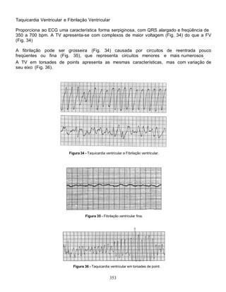 353
Taquicardia Ventricular e Fibrilação Ventricular
Proporciona ao ECG uma característica forma serpiginosa, com QRS alargado e freqüência de
350 a 700 bpm. A TV apresenta-se com complexos de maior voltagem (Fig. 34) do que a FV
(Fig. 34)
A fibrilação pode ser grosseira (Fig. 34) causada por circuitos de reentrada pouco
freqüentes ou fina (Fig. 35), que representa circuitos menores e mais numerosos.
A TV em torsades de points apresenta as mesmas características, mas com variação de
seu eixo (Fig. 36).
Figura 34 - Taquicardia ventricular e Fibrilação ventricular.
Figura 35 - Fibrilação ventricular fina.
Figura 36 - Taquicardia ventricular em torsades de point.
 