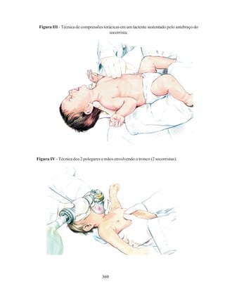 369
Figura III - Técnica de compressões torácicas em um lactente sustentado pelo antebraço do
socorrista.
Figura IV - Técnica dos2 polegares emãos envolvendo o tronco (2 socorristas).
 
