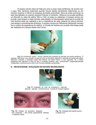 - 78 -
O acesso venoso deve ser feito por uma ou duas veias periféricas, de acordo com
o caso. Nos membros superiores quando houver lesões penetrantes abdominais ou em
membro superior e inferior na presença de lesões precordiais. Deve-se evitar puncionar no
lado traumatizado ou quando existirem fraturas à montante. Utiliza-se na punção periférica
um Abocath ou Jelco de calibre 16G ou 14G, no braço ou antebraço. O acesso venoso por
punção, para acesso a veias centrais, está abolido no traumatizado nesta fase.A punção da
veia femoral pode ser realizada e tem a importância de estar distante da coluna cervical,
vias aéreas e procedimentos torácicos. O acesso venoso por flebotomia (dissecção venosa)
fica a critério da experiência do médico. A infusão de líquidos por punção intra-óssea pode
ser realizada em crianças abaixo dos 6 anos.
Fig. 7.3 - Enchimento capilar – técnica utilizada para avaliação da perfusão dos tecidos periféricos. É
realizada fazendo-se uma pressão na base da unha ou nos lábios, passando a coloração de rosada para pálida.
Retirando a pressão, a coloração rosada deve retomar num tempo inferior a dois segundos. Se o tempo
ultrapassar dois segundos é sinal de que a circulação periférica está comprometida (oxigenação/perfusão
inadequadas). Lembre-se que à noite e com frio essa avaliação é prejudicada.
D. INCAPACIDADE: AVALIAÇÃO DO ESTADO NEUROLÓGICO
Fig. 7.7 - Avaliação do nível de consciência – estímulo
doloroso aplicado comprimindo-se a borda do músculo trapézio.
Fig. 7.8 - Pupilas de tamanhos desiguais Fig. 7.9 - Avaliação das pupilas quanto
(ani- socóricas) – olho direito apresentando midríase a reação a luz.
e esquerdo miose.
 
