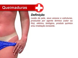 Lesão da pele, seus anexos e estruturas,
produzida por agente térmico (calor ou
frio), elétrico, biológico, produto químico
e/ou irradiação ionizante.
DefiniçãoDefinição
 