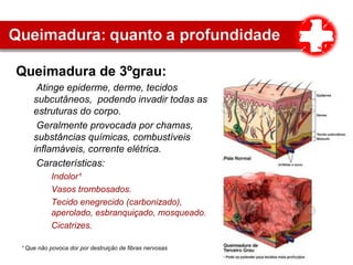 Queimadura de 3ºgrau:
Atinge epiderme, derme, tecidos
subcutâneos, podendo invadir todas as
estruturas do corpo.
Geralmente provocada por chamas,
substâncias químicas, combustíveis
inflamáveis, corrente elétrica.
Características:
Indolor¹
Vasos trombosados.
Tecido enegrecido (carbonizado),
aperolado, esbranquiçado, mosqueado.
Cicatrizes.
¹ Que não povoca dor por destruição de fibras nervosas
 