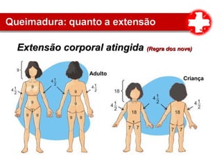 Extensão corporal atingidaExtensão corporal atingida (Regra dos nove)(Regra dos nove)
Adulto
Criança
 
