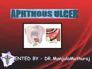 APHTHOUS ULCER PRESENTED BY – DR.ManjulaMuthuraj manju 