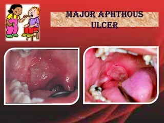 MINOR APHTHOUS ULCERArea of ulceration with surrounding erythema present on movable mucosa of left maxillary muco-buccal fold.manju