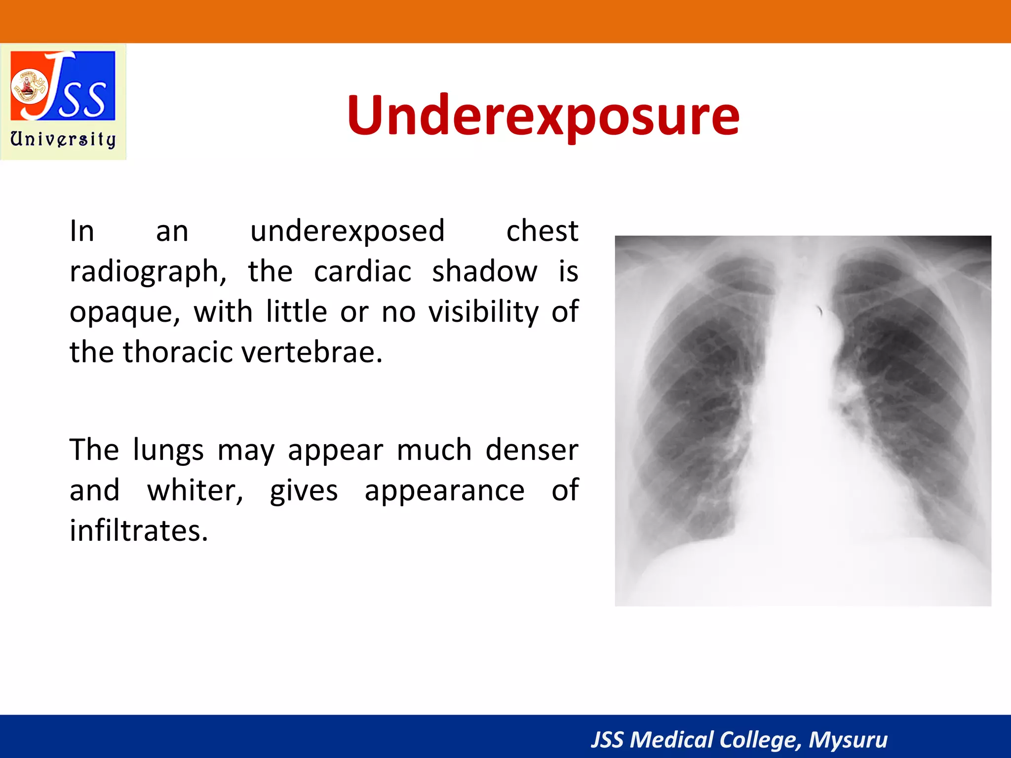 Approach to Chest X-Ray and Interpretation | PPT