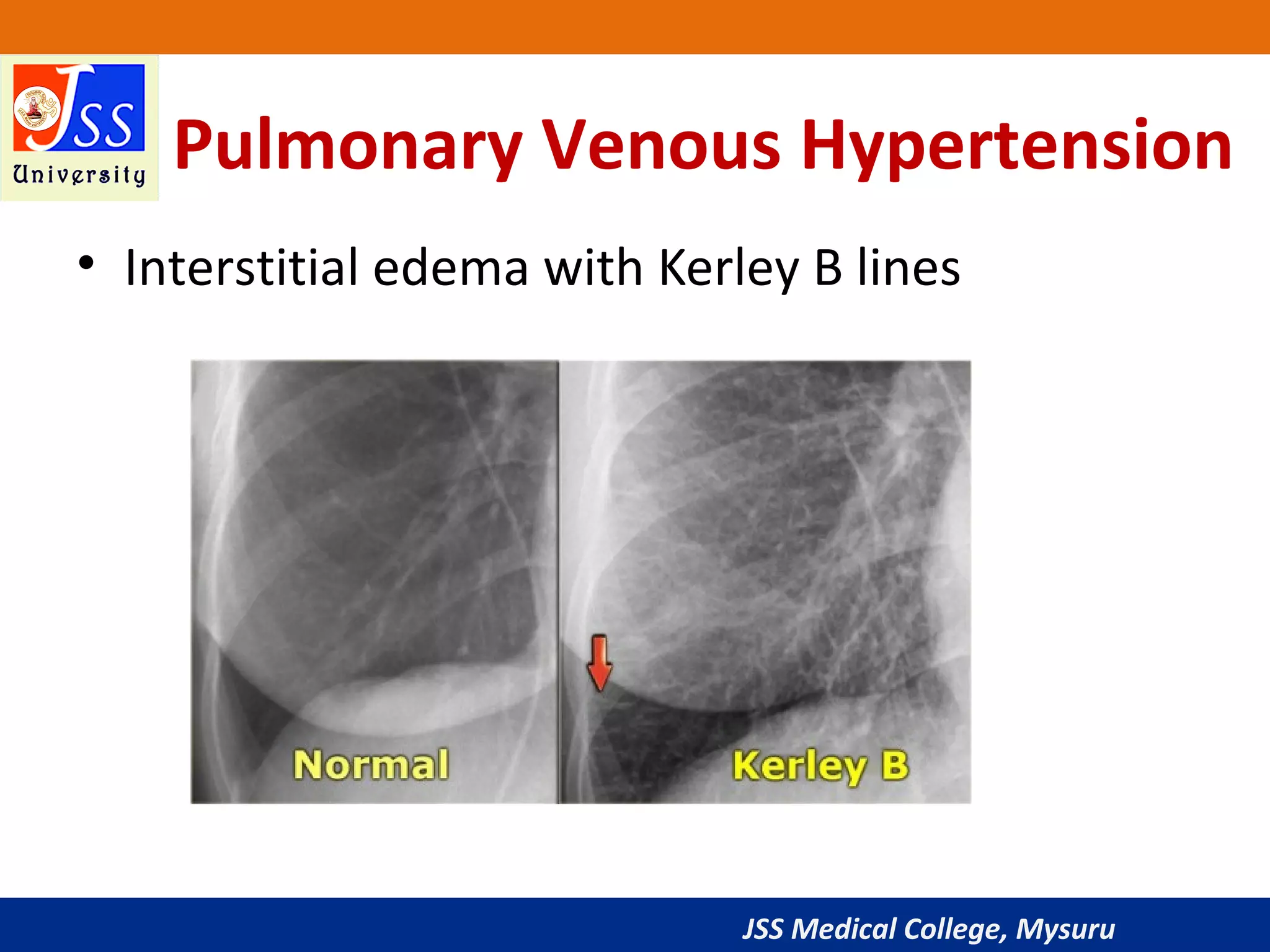 Approach to Chest X-Ray and Interpretation | PPT