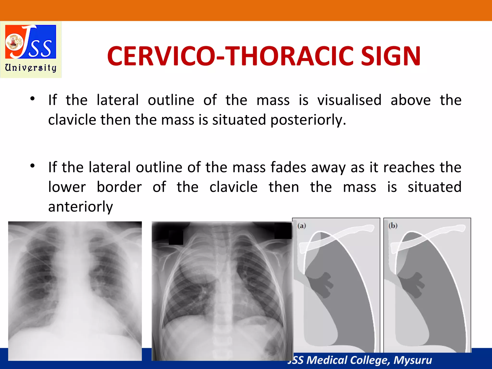 Stuart Sign Cervical Approach to Chest X-Ray and Interpretation | PPT