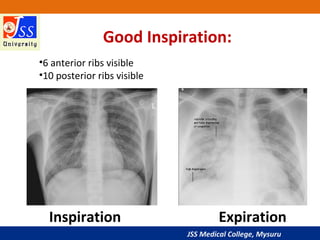 JSS Medical College, Mysuru
Inspiration Expiration
Good Inspiration:
•6 anterior ribs visible
•10 posterior ribs visible
 
