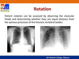 JSS Medical College, Mysuru
Rotation
Patient rotation can be assessed by observing the clavicular
heads and determining whether they are equal distance from
the spinous processes of the thoracic vertebral bodies.
 