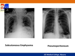 JSS Medical College, Mysuru
Subcutaneous Emphysema Pneumoperitoneum
 