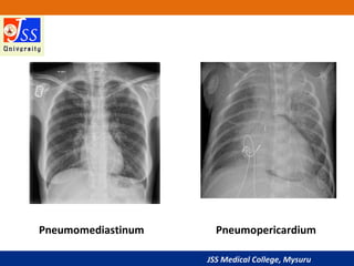 JSS Medical College, Mysuru
Pneumomediastinum Pneumopericardium
 
