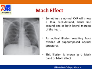 JSS Medical College, Mysuru
Mach Effect
• Sometimes a normal CXR will show
a thin, well-defined, black line
around one or both lateral margins
of the heart.
• An optical illusion resulting from
overlap of superimposed normal
structures.
• This illusion is known as a Mach
band or Mach effect
 