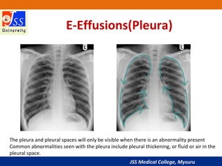 JSS Medical College, Mysuru
E-Effusions(Pleura)
The pleura and pleural spaces will only be visible when there is an abnormality present
Common abnormalities seen with the pleura include pleural thickening, or fluid or air in the
pleural space.
 