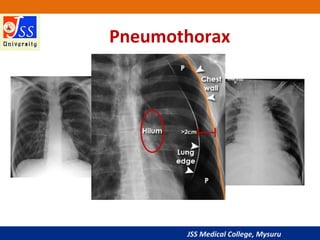JSS Medical College, Mysuru
Pneumothorax
 