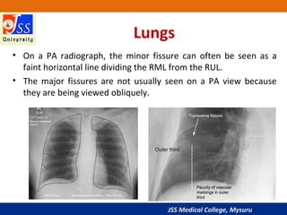 JSS Medical College, Mysuru
Lungs
• On a PA radiograph, the minor fissure can often be seen as a
faint horizontal line dividing the RML from the RUL.
• The major fissures are not usually seen on a PA view because
they are being viewed obliquely.
 