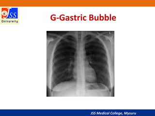 JSS Medical College, Mysuru
G-Gastric Bubble
 