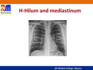JSS Medical College, Mysuru
H-Hilum and mediastinum
 