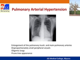 JSS Medical College, Mysuru
Pulmonary Arterial Hypertension
Enlargement of the pulmonary trunk and main pulmonary arteries
Disproportionately small peripheral vessels
Oligemic lungs
Prune tree appearance
 