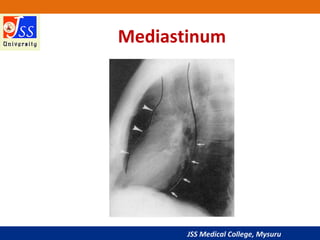JSS Medical College, Mysuru
Mediastinum
 