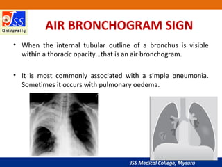 JSS Medical College, Mysuru
AIR BRONCHOGRAM SIGN
• When the internal tubular outline of a bronchus is visible
within a thoracic opacity…that is an air bronchogram.
• It is most commonly associated with a simple pneumonia.
Sometimes it occurs with pulmonary oedema.
 